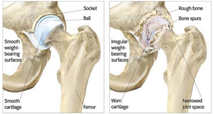 Hip Replacement homepage